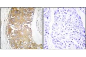 Immunohistochemistry analysis of paraffin-embedded human breast carcinoma tissue, using FRK Antibody. (FRK anticorps  (AA 71-120))