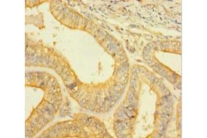 Immunohistochemistry of paraffin-embedded human endometrial cancer using ABIN7146926 at dilution of 1:100 (Caspase 1 anticorps  (AA 120-269))
