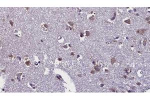 ABIN6276443 at 1/100 staining Human brain cancer tissue by IHC-P. (TLR7 anticorps  (Internal Region))