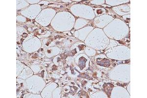 Immunohistochemistry of paraffin-embedded Human breast cancer using TAX1BP1 Polyclonal Antibody at dilution of 1:100 (40x lens). (TAX1BP1 anticorps)