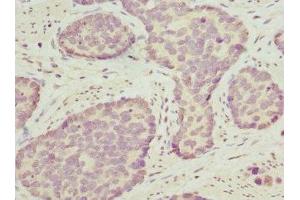 Immunohistochemistry of paraffin-embedded human gastric cancer using ABIN7162208 at dilution of 1:100 (Oligophrenin 1 anticorps  (AA 1-270))