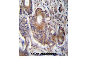 RAB21 Antibody (C-term) (ABIN657300 and ABIN2846383) immunohistochemistry analysis in formalin fixed and paraffin embedded human colon carcinoma followed by peroxidase conjugation of the secondary antibody and DAB staining. (RAB21 anticorps  (C-Term))