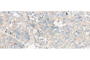 Immunohistochemistry of paraffin-embedded Human liver cancer tissue using ZNF449 Polyclonal Antibody at dilution of 1:50(x200) (ZNF449 anticorps)