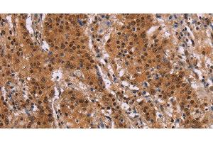 Immunohistochemistry of paraffin-embedded Human gastic cancer using FOSL1 Polyclonal Antibody at dilution of 1:30 (FOSL1 anticorps)
