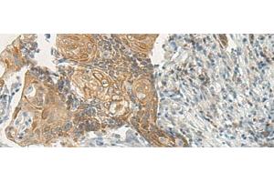 Immunohistochemistry of paraffin-embedded Human cervical cancer tissue using VIPR2 Polyclonal Antibody at dilution 1:35 (VIPR2 anticorps)