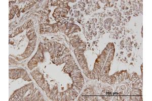 Immunoperoxidase of monoclonal antibody to ERBB3 on formalin-fixed paraffin-embedded human lung cancer.