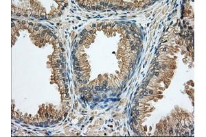 Immunohistochemical staining of paraffin-embedded Human liver tissue using anti-RAB17 mouse monoclonal antibody. (RAB17 anticorps)