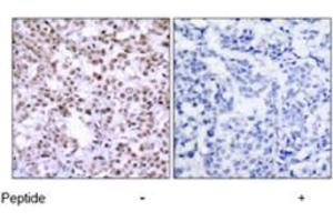 Immunohistochemical analysis of paraffin-embedded human breast carcinoma tissue using CHEK2 polyclonal antibody  . (CHEK2 anticorps)