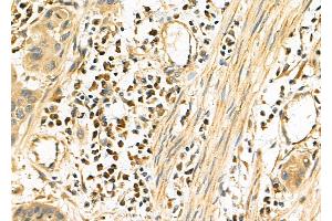 ABIN6257103 and ABIN6275869 at 1/100 staining Human esophageal cancer by IHC-P.