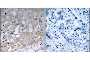 Immunohistochemistry analysis of paraffin-embedded human breast carcinoma tissue, using VEGFR2 (Ab-1175) Antibody. (VEGFR2/CD309 anticorps  (AA 1141-1190))