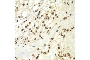 Immunohistochemistry of paraffin-embedded human kidney cancer using RPA2 Antibody (ABIN5971215) at dilution of 1/100 (40x lens). (RPA2 anticorps)