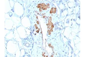 Formalin-fixed, paraffin-embedded human Breast Carcinoma stained with SM-MHC Recombinant Rabbit Monoclonal Antibody (MYH11/2303R). (Recombinant MYH11 anticorps)