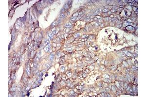 Immunohistochemical analysis of paraffin-embedded rectum cancer tissues using CD44 mouse mAb with DAB staining.