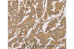 Immunohistochemistry of Human breast cancer using DMRT3 Polyclonal Antibody at dilution of 1:50 (DMRT3 anticorps)