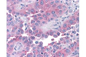 Anti-T1R1 / TAS1R1 antibody IHC of human Lung, Non-Small Cell Carcinoma. (TAS1R1 anticorps  (Cytoplasmic Domain))