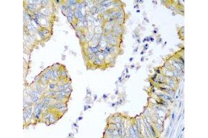 Immunohistochemistry of paraffin-embedded Human colon carcinoma using KRBOX4 Polyclonal Antibody at dilution of 1:200 (40x lens). (KRAB Box Domain Containing 4 (KRBOX4) anticorps)