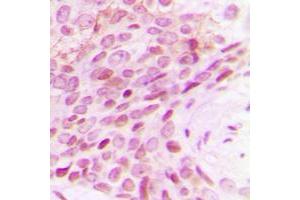Immunohistochemical analysis of POLR2E staining in human breast cancer formalin fixed paraffin embedded tissue section.