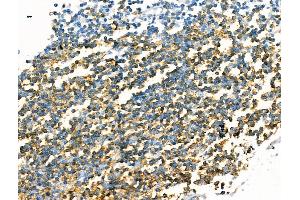 ABIN7094516 and ABIN7098565 at 1/100 staining Human breast cancer by IHC-P.