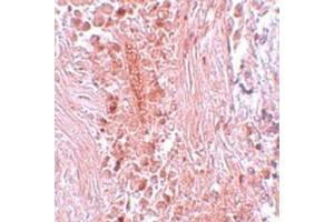 Immunohistochemical staining of human breast cancer tissue with PIAS3 polyclonal antibody  at 5 ug/mL dilution. (PIAS3 anticorps  (C-Term))