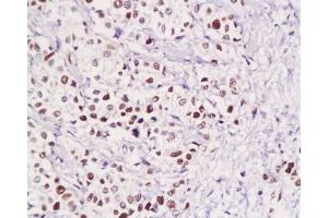 Formalin-fixed and paraffin embedded human gastric carcinoma with Anti-Pokemon Polyclonal Antibody, Unconjugated  at 1:200, followed by conjugation to the secondary antibody and DAB staining (ZBTB7A anticorps  (AA 151-250))