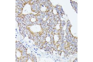 Immunohistochemistry of paraffin-embedded human colon carcinoma using  antibody (ABIN6131166, ABIN6136417, ABIN6136418 and ABIN6223845) at dilution of 1:100 (40x lens).