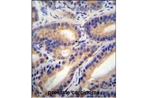 HSD11B1L Antibody (C-term) (ABIN655425 and ABIN2844963) immunohistochemistry analysis in formalin fixed and paraffin embedded human prostate carcinoma followed by peroxidase conjugation of the secondary antibody and DAB staining. (HSD11B1L anticorps  (C-Term))