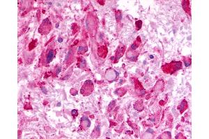 Anti-LPHN3 / Latrophilin-3 antibody IHC of human Brain, Glioblastoma. (LPHN3 anticorps  (C-Term))