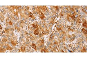 Immunohistochemistry of paraffin-embedded Human liver cancer using CDC46 Polyclonal Antibody at dilution of 1:40 (MCM5 anticorps)