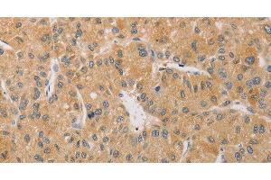 Immunohistochemistry of paraffin-embedded Human liver cancer tissue using ARSK Polyclonal Antibody at dilution 1:30 (Arylsulfatase K anticorps)