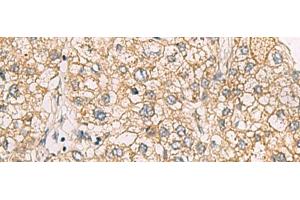 Immunohistochemistry of paraffin-embedded Human liver cancer tissue using CHST2 Polyclonal Antibody at dilution of 1:30(x200) (CHST2 anticorps)