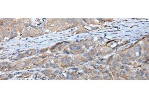 Immunohistochemistry of paraffin-embedded Human breast cancer tissue using GPC5 Polyclonal Antibody at dilution of 1:40(x200) (GPC5 anticorps)