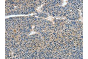 The image on the left is immunohistochemistry of paraffin-embedded Human liver cancer tissue using ABIN7128589(ATP4B Antibody) at dilution 1/40, on the right is treated with fusion protein. (ATP4b anticorps)