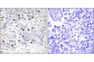 Immunohistochemistry analysis of paraffin-embedded human breast carcinoma tissue, using TEAD2 Antibody. (TEAD2 anticorps  (AA 71-120))