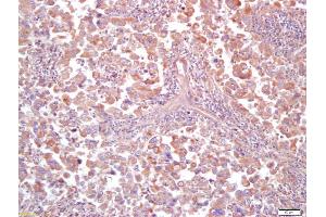 Formalin-fixed and paraffin embedded human lung carcinoma labeled with Anti MT-ND5Polyclonal Antibody (ABIN751633), Unconjugated at 1:200, followed by conjugation to the secondary antibody and DAB staining (MT-ND5 anticorps  (AA 451-550))