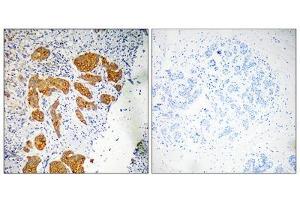 Immunohistochemistry analysis of paraffin-embedded human breast carcinoma tissue, using CKLF4 antibody. (CKLF anticorps  (Internal Region))