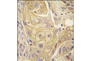 Formalin-fixed and paraffin-embedded human lung carcinoma tissue reacted with EphB2 antibody, which was peroxidase-conjugated to the secondary antibody, followed by DAB staining. (EPH Receptor B2 anticorps)