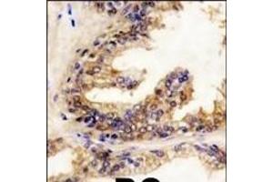 Formalin-fixed and paraffin-embedded human prostata carcinoma reacted with BRAF Antibody (Center) (ABIN392246 and ABIN2841936) , which was peroxidase-conjugated to the secondary antibody, followed by DAB staining. (SNRPE anticorps  (AA 424-453))