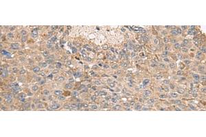 Immunohistochemistry of paraffin-embedded Human liver cancer tissue using ABCA10 Polyclonal Antibody at dilution of 1:50(x200) (ABCA10 anticorps)