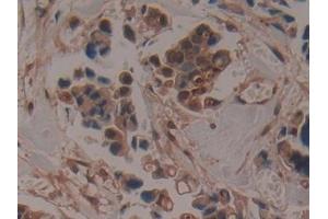 Detection of ADAMTS5 in Human Breast cancer Tissue using Polyclonal Antibody to A Disintegrin And Metalloproteinase With Thrombospondin 5 (ADAMTS5)