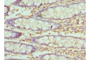 Immunohistochemistry of paraffin-embedded human colon cancer using ABIN7175510 at dilution of 1:100 (Villin 1 anticorps  (AA 1-350))