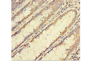 Immunohistochemistry of paraffin-embedded human colon cancer using ABIN7152460 at dilution of 1:100 (FBXL17 anticorps  (AA 1-303))