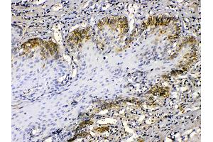 Cytokeratin 14 was detected in paraffin-embedded sections of human oesophagus squama cancer tissues using rabbit anti- Cytokeratin 14 Antigen Affinity purified polyclonal antibody (Catalog # ) at 1 µg/mL.