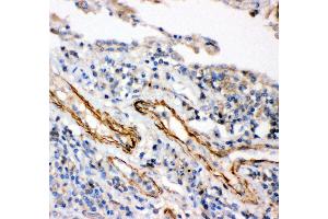 Anti- IKK beta antibody,IHC(P) IHC(P): Human Lung Cancer Tissue