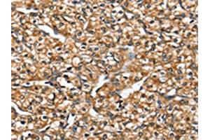 The image on the left is immunohistochemistry of paraffin-embedded Human prostate cancer tissue using ABIN7192449(SLC26A5 Antibody) at dilution 1/20, on the right is treated with synthetic peptide. (SLC26A5 anticorps)