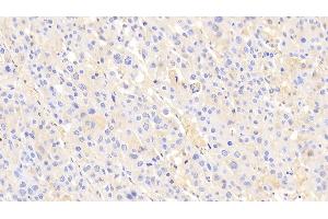 Detection of a2M in Human Liver cancer Tissue using Polyclonal Antibody to Alpha-2-Macroglobulin (a2M)