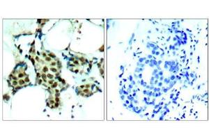 Immunohistochemical analysis of paraffin-embedded human breast carcinoma tissue, using P38 MAPK (phospho- Tyr182) antibody (E011253). (MAPK14 anticorps  (pTyr182))
