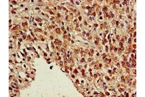 Immunohistochemistry of paraffin-embedded human glioma using ABIN7161911 at dilution of 1:100 (NR5A2 + LRH1 anticorps  (AA 182-291))