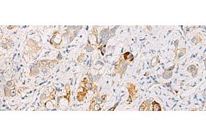 Immunohistochemistry of paraffin-embedded Human liver cancer tissue using DHRS2 Polyclonal Antibody at dilution of 1:50(x200) (DHRS2 anticorps)