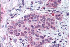 Human Breast Carcinoma (formalin-fixed, paraffin-embedded) stained with MMP13 antibody ABIN301763 at 17 ug/ml followed by biotinylated goat anti-rabbit IgG secondary antibody ABIN481713, alkaline phosphatase-streptavidin and chromogen. (MMP13 anticorps  (N-Term))