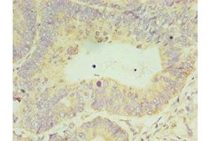 Immunohistochemistry of paraffin-embedded human colon cancer using ABIN7150731 at dilution of 1:100 (CLK2 anticorps  (AA 240-499))
